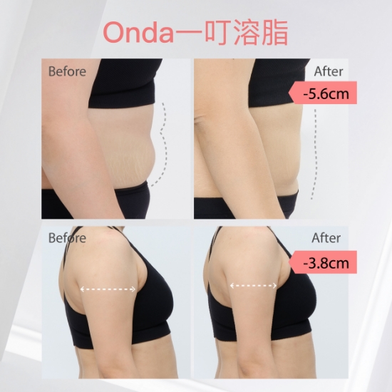 Onda 一叮溶脂