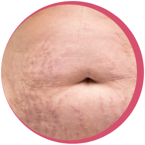 雙膠原妊娠紋修復槍