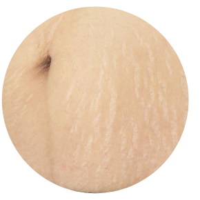 雙膠原妊娠紋修復槍